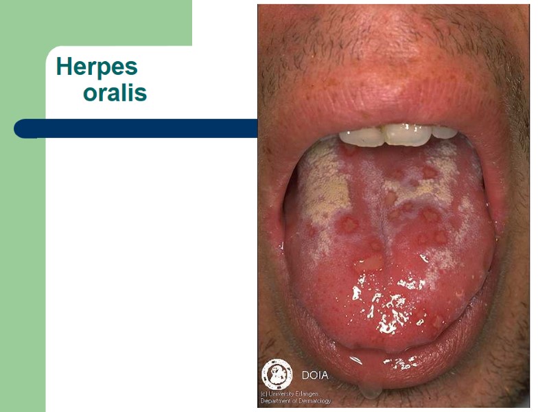 Herpes     oralis